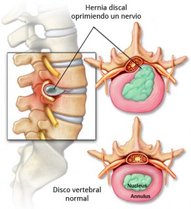Hernia-discal-fisioterapia-zaragoza