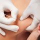 fisioterapia-punción-seca
