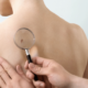 cancer de piel prevenir